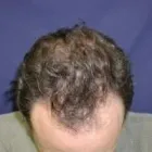 Business 4 image MEN'S HAIR GROWTH CENTER Hair Removal in Cincinnati OH